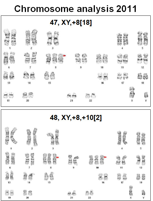 Figure 6. Chromosomal analysis showed abnormal male karyotype:  47, XY,+8[18]/48, XY +8,+10[2]. 